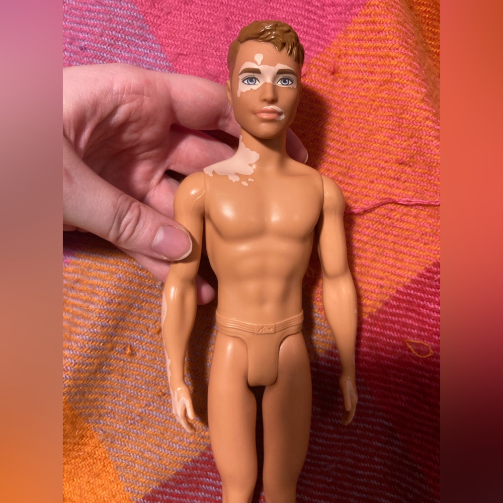 B1G2 - Fashion Doll Ken Male Barbie Vitiligo - Buy 1, Get 2 FREE